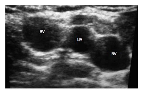 Focus on peripherally inserted central catheters in critically ill patients