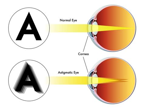 Laser Eye Surgery for Astigmatism - LESH