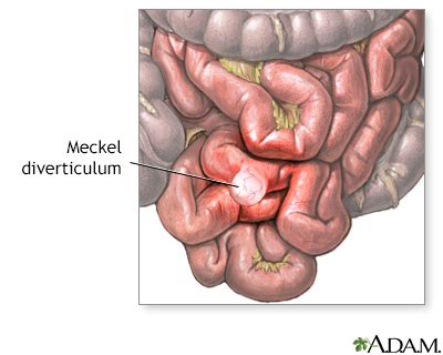 Abscess - abdomen or pelvis Information | Mount Sinai - New York