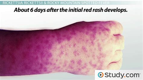 Spotted Fevers: Symptoms of Rickettsia Infections - Lesson | Study.com