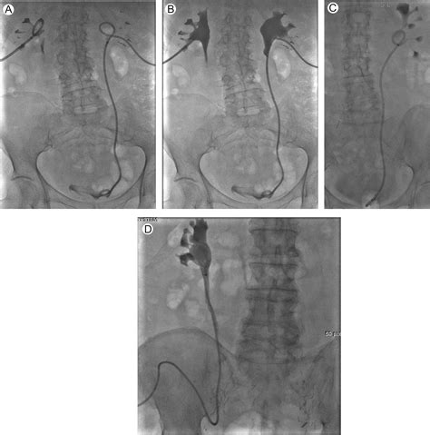 Urinary Drainage Procedures in Interventional Radiology - Techniques in Vascular ...