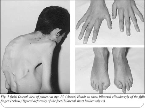 Myositis ossificans