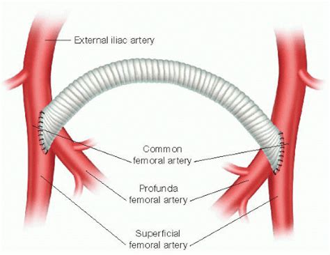 Extrathoracic Revascularization (Carotid-Carotid, Carotid-Subclavian Bypass and Transposition ...