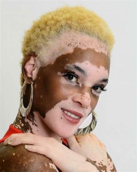 My beauty is in my difference! Pretty People, Beautiful People, Vitiligo Treatment, Unique Faces ...