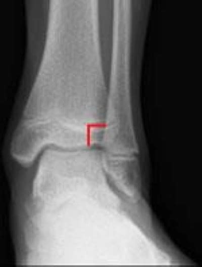 Ankle Fractures In Children - OrthoInfo - AAOS