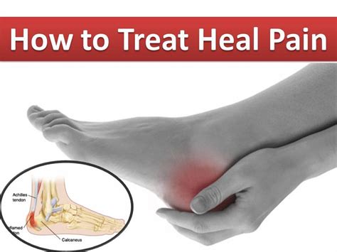 How to Treat Heel Pain Easily | Cure Heel Pain - YouTube