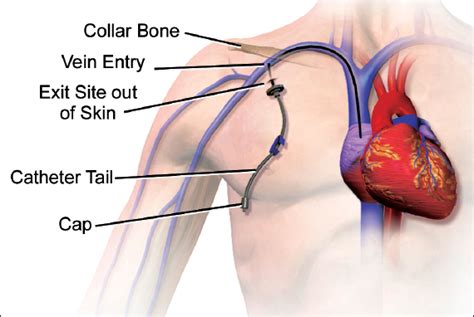 Figure 5. Non-tunneled central venous catheter - Variation in the Care of Surgical Conditions ...