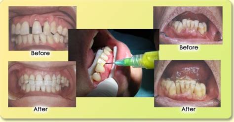 Ti-eS Metrodinazole Gel || decreased pocket, increased attachment