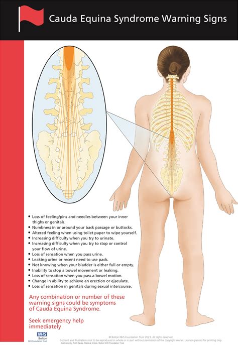 Cauda equina syndrome - healthcare professionals