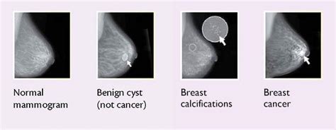 Breast Changes and Conditions - NCI