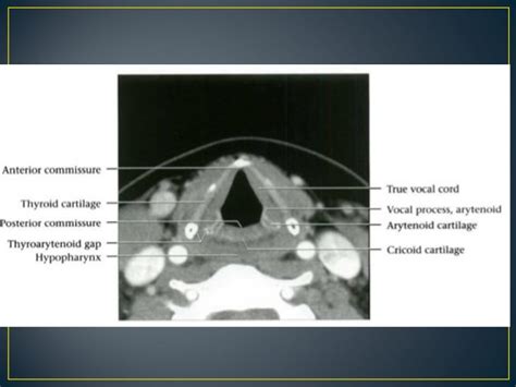 Larynx anatomy ct and mri