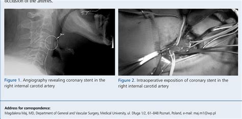 Figure 1 from Dislocation of a bare metal stent from the left main coronary artery to the right ...