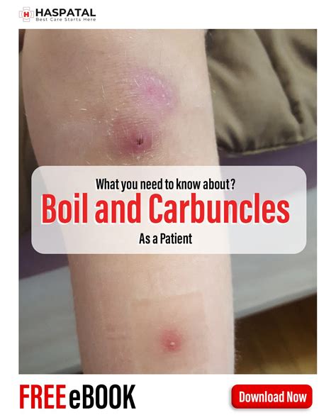 How boils and Carbuncles can affect your body? Haspatal online consultation app - Haspatal｜Easy ...