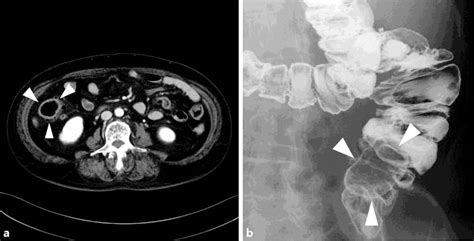 Figure 1 from Successful Endoscopic Submucosal Dissection of a Large Terminal Ileal Lipoma ...