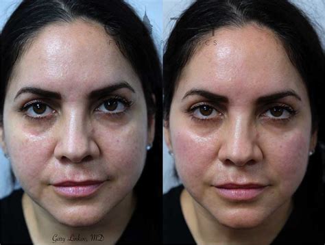 NYC Cheek Filler Before and After Pictures | New York | UES