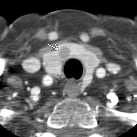 Zollinger-Ellison Syndrome | Clinical Gate