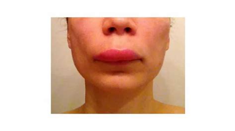 Chronic Urticaria Swelling Lips | Lipstutorial.org