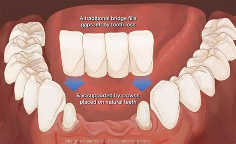 Dental Bridge Stockbridge, GA - Atlanta, GA - Dental Group South, Inc.