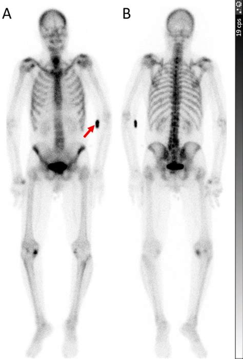 -71 year-old man with prostate cancer. Whole-body bone scan was ...