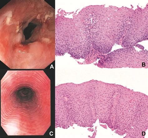 (A) Endoscopic appearance of ulcerative esophagitis secondary to severe... | Download Scientific ...