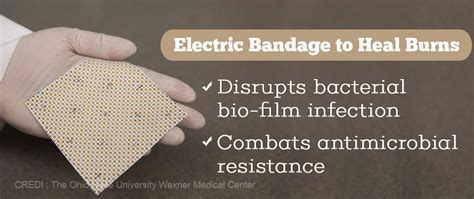 Electric Bandages Help Fight Antimicrobial Resistance in Burns