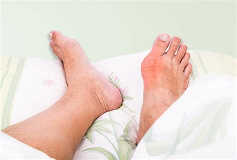 How to Ease a Gout Attack: Home Remedies & Self-Care Tips