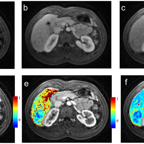 Liver perfusion maps for a patient with hepatocellular carcinoma. Free... | Download Scientific ...