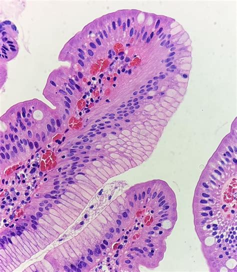 Foveolar metaplasia of the duodenum : r/pathology