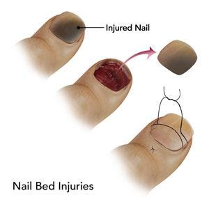 Nail Bed Injuries Las Vegas | Nail Bed Infection Boulder City NV