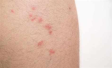 Flea Bites on Humans — Pictures, Treatment and Prevention