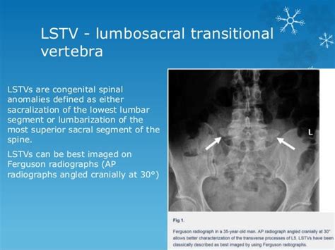 Transitional vertebrae radiology