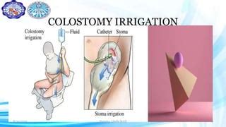 Colostomy irrigation | PPT