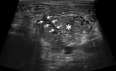 Isolated partial rupture of the medial head of the gastrocnemius muscle ...