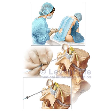 Epidural vs. Spinal Anaesthesia | Dr. Efe’s Medical Art Store: Medical ...