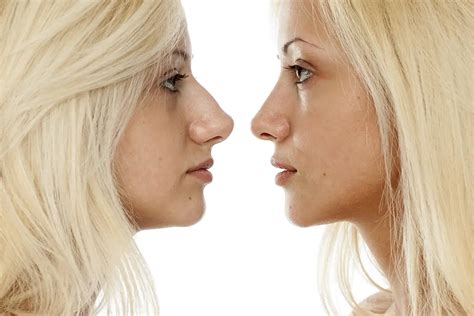 How long does it take to recover from a nose job (rhinoplasty)? - Sand Plastic Surgery of Spokane