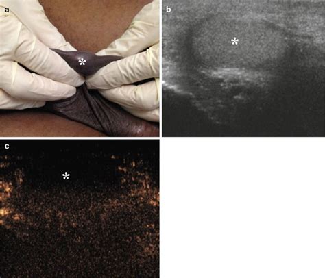 Scrotal Masses | Abdominal Key