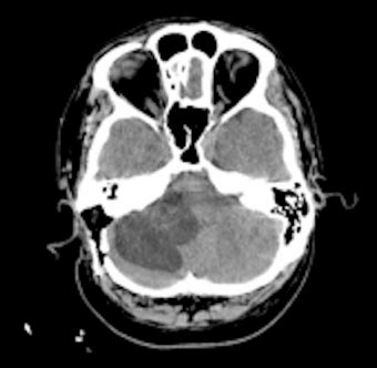 Diffusion MRI showing no restricted diffusion. | Download Scientific ...