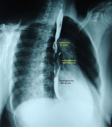 Normal indentations on the esophagus in barium swallow - Right anterior oblique view chest X-ray ...