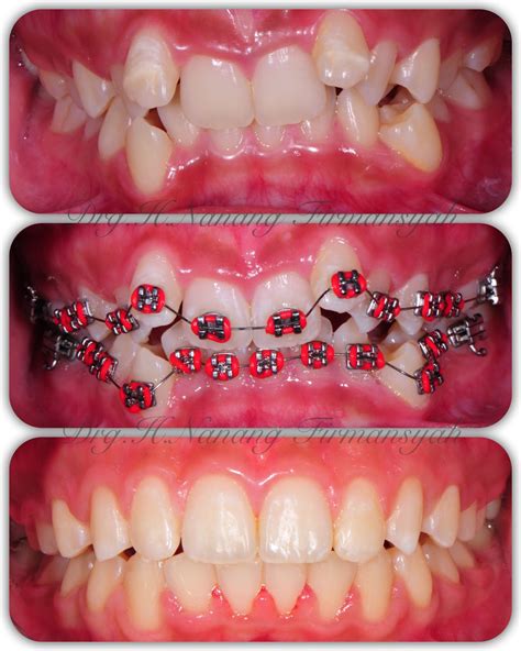 Pin on Braces | Invisible teeth braces, Orthodontics braces, Dental braces