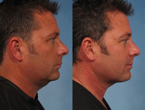 Male Face/Neck Lift Before and After Pictures Case 163 | Naples and Ft. Myers, FL | Kent V ...