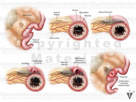 Stock Bowel: Anomalies / Obstructions / Injuries — Illustrated Verdict