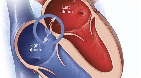 Le Foramen Ovale | AVGPlongee