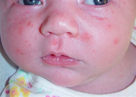 Neonatal Acne (Acne - neonatal and infantile)