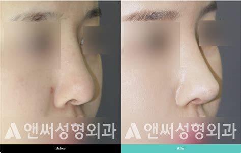 Nose Bridge Correction and Augmentation | Answer Plastic Surgery