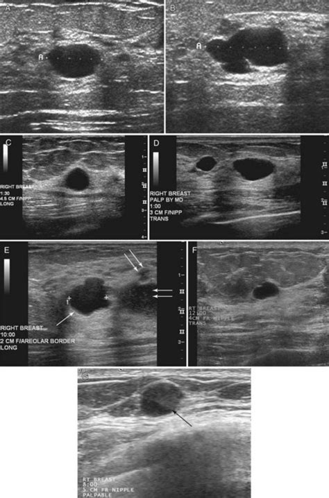 Breast Cyst Ultrasound