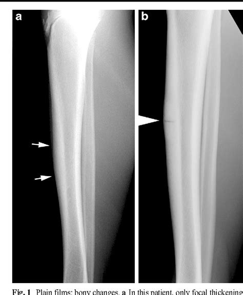 Stress fracture shin mri - xchangebatman