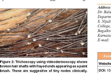 Trichoscopy of an Isolated Trichorrhexis Nodosa: A Case Report | Semantic Scholar