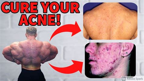 Cure Your Acne / Bacne | Steroid Acne | Doctor's Analysis - YouTube