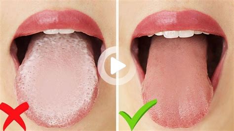 SELF CARE TIPS AND HOME REMEDIES TO TREAT A WHITE TONGUE ...