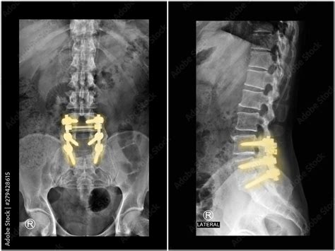 Film x-ray radiograph lumbar spine showing spinal stenosis treated by decompressive laminectomy ...